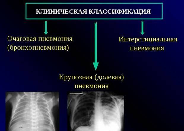 Пневмония: симптомы у взрослых, лечение и профилактика