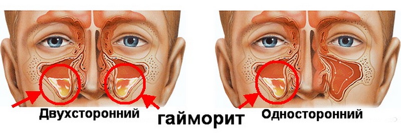 Какие признаки появления гайморита у взрослых